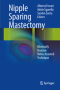 Nipple Sparing MastectomyMinimally Invasive Video-Assisted Technique /