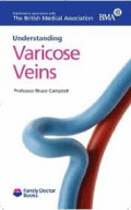 Understanding varicose veins